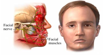 Emiten recomendaciones para prevenir una parálisis facial periférica