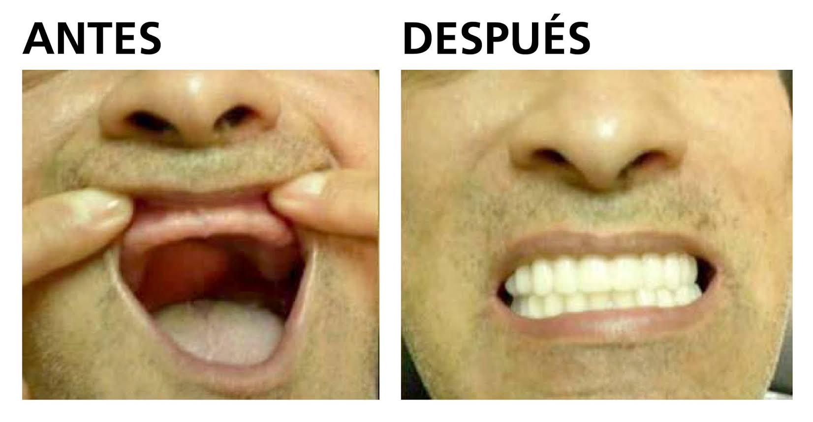 Benefician a internos del Cereso de Tijuana con prótesis dentales