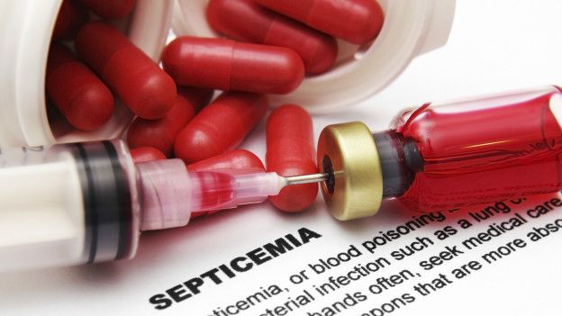 ¿Qué es la septicemia, por qué mata tanta gente y es tan difícil de detectar?