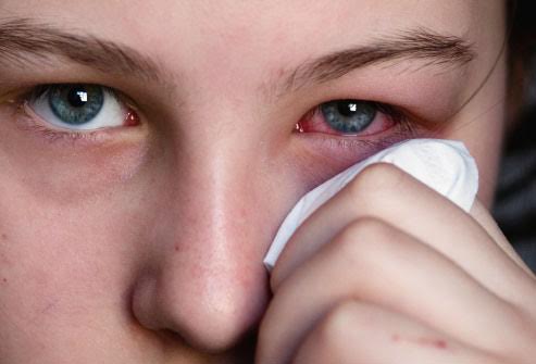 La conjuntivitis, infección común en los ojos