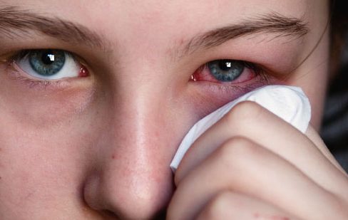 En nariz y ojos se presentan las principales afectaciones ante la condición Santa Ana