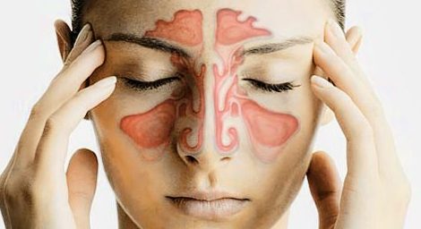 Emiten recomendaciones para prevenir la sinusitis