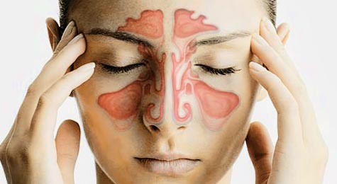 Exhortan a prevenir la sinusitis